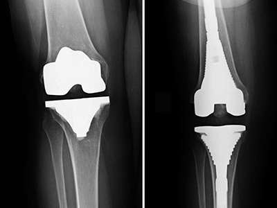 revision-knee-replacement