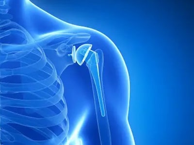 shoulder-replacement-surgery