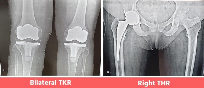 Bilateral-TKR-Right-THR-Smt Chikara