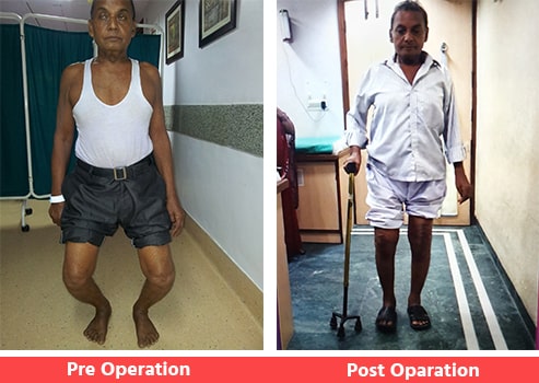 Knee-Surgery-for-Deformity-Correction-TKR
