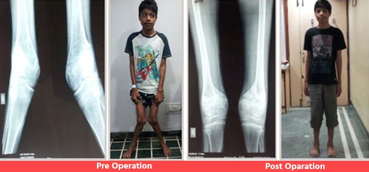 Knee-Surgery-for-Deformity-Correction