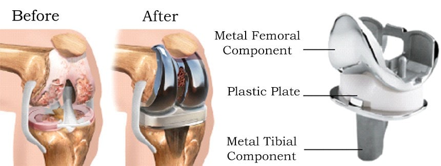 Knee-joint-Replacement