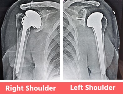 Left-&-Right-Shoulder-Replacement