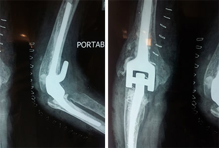 Post-Op-X-Ray-Elbow-Replacement