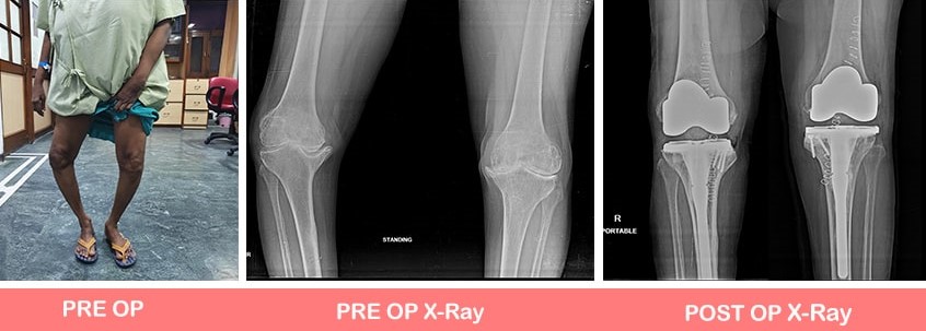 Primary-complex-Total-Knee-Replacement-min