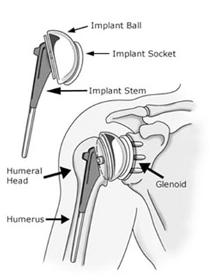 Shoulder-joint-replacement