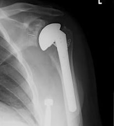  Total-shoulder-replacement