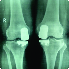 X-Ray of Replaced Uni Condylar Knee