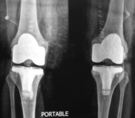 X-rays-shows-optimal-alignment-of-the-implants