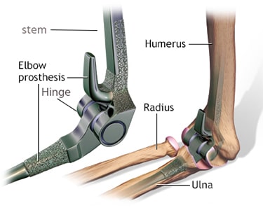 elbow-replacement