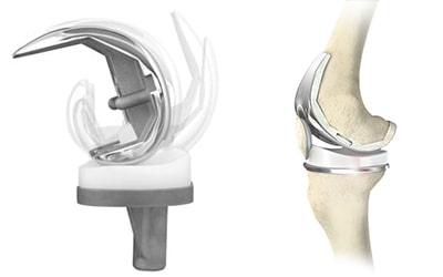 knee-implants