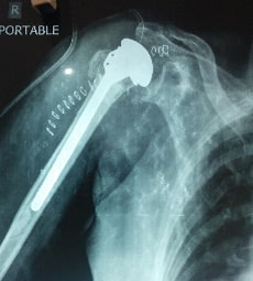 partial-hemi-shoulder-replacement-x-ray-after