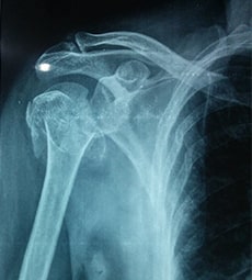 partial-hemi-shoulder-replacement-x-ray-before