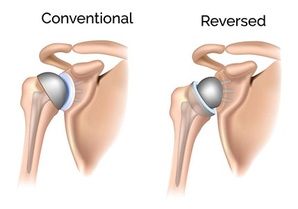 reverse-shoulder-replacement