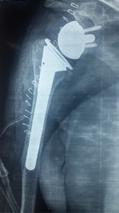 reverse-shoulder-replacement-post-x-ray