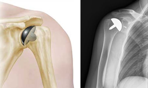 shoulder-resurfacing-arthroplasty