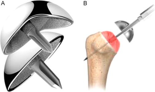 shoulder-resurfacing-arthroplasty