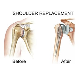  total-shoulder-replacement-illustration