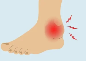 Arthritis-in-Ankle