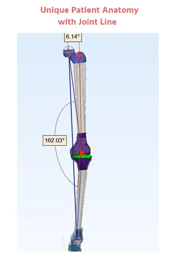 Customized-Knee