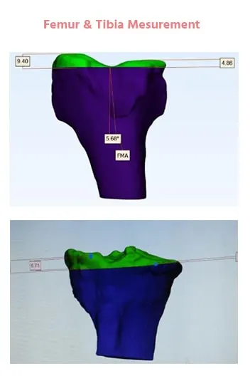 Customized-Knee-2