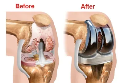 Knee-Artheretis