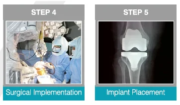 Knee-Joint-Replacement-Process-2