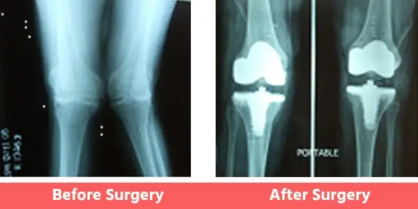 Knock-Knees-Valgus