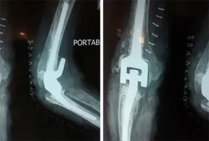 Post-Op-X-Ray-Elbow-Replacemnt