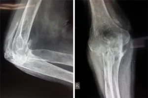 Pre-Op-X-Ray-Elbow-Replacemnt