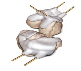 The-patient-specific-instruments