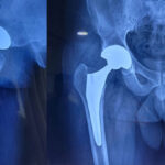 hip-replacement