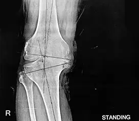 osteoarthritis-patient-with-varus-deformity-of-knees