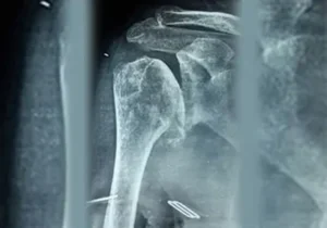 reverse-shoulder-replacement-pre-op-x-ray