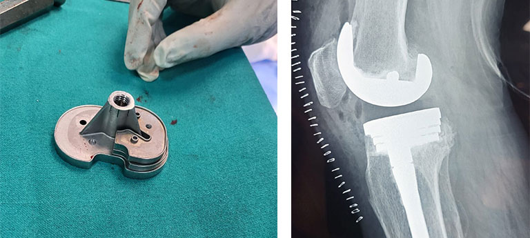 Customized-Knee