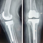 tkr-surgery-2