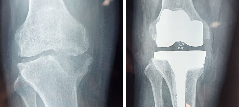 Customized-Knee-2