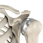 partial-hemi-shoulder-replacement