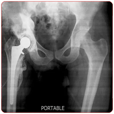 post_op_hip_replacement