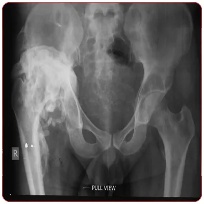 pre_op_hip_replacement